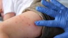 България е на първо място в Европа по регистрирани случаи на морбили, най-много са във Враца
