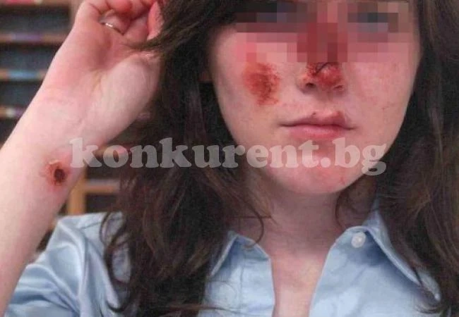 17-годишна със счупен нос, пребита от гаджето си