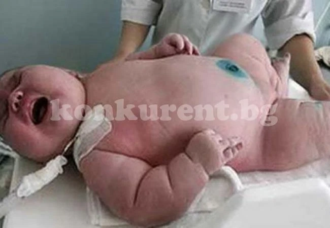 Рекорд за Гинес: 200-килограмова майка роди гигантско бебе - 18 кила
