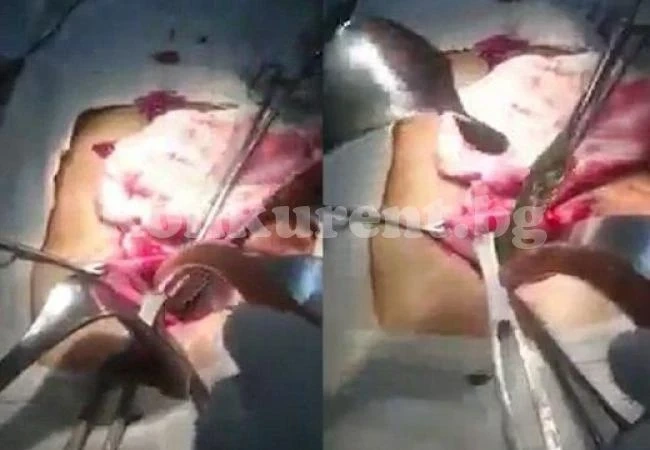 Хирург извади 18 четки за зъби от стомах на пациент (ВИДЕО)