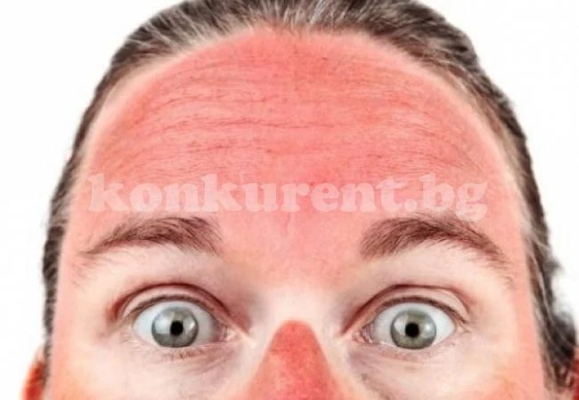 Внимавайте със слънцето! Толкова опасно е, колкото тютюнопушенето!