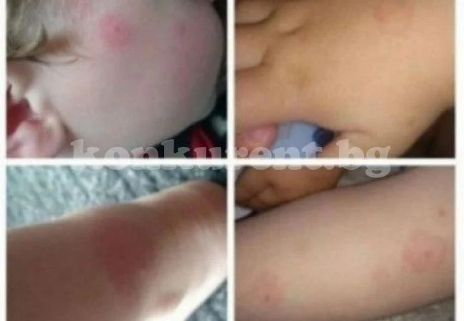 Ако забележите нещо такова по кожата на детето си, веднага тичайте при лекаря!