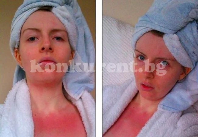 Жена живее в истински кошмар, алергична е към... вода!