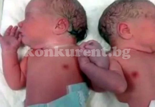 Разделят сиамците на 14-годишната родилка другото лято