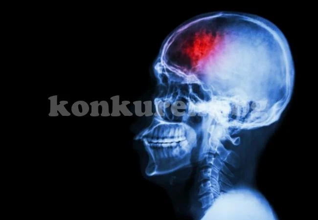 Много полезно: Ето как да постъпим, ако някой около нас получи инсулт