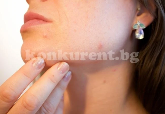 Ако имате проблеми с пъпките, то ЗАДЪЛЖИТЕЛНО спрете тези храни