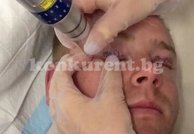 Мъж се събуди с татуировки върху клепачите след запой