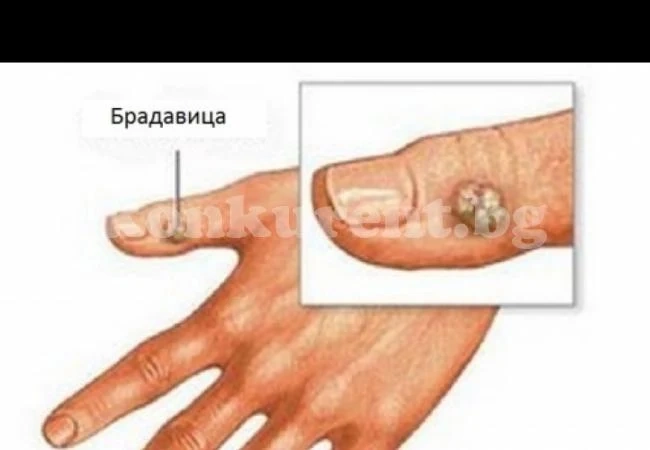 Забравете за брадавиците с този доста нетрадиционен, но не по-малко удачен метод  