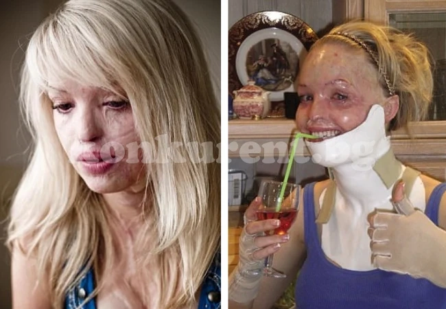 Обезобразена от киселина жена решава да се самоубие, но се случва нещо невероятно, което преобръща живота й! (СНИМКИ)