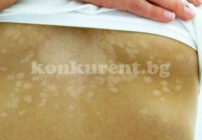 Това са 5-те кожни симптома, че се разболяваме