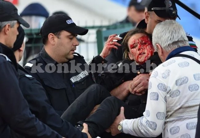 Ранената на дербито полицайка в операция, може да загуби едното си око (Снимки 18+)