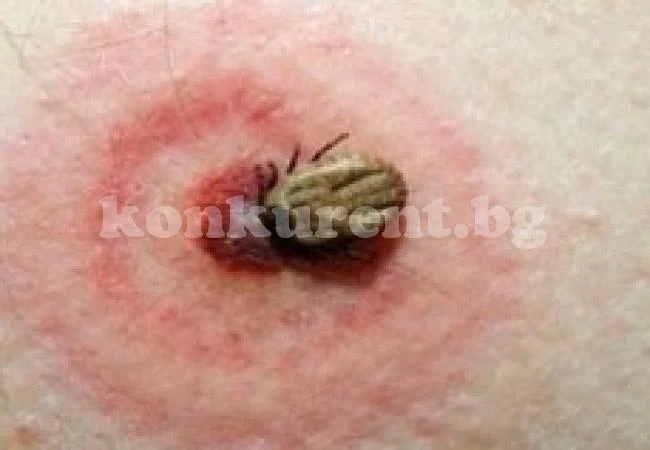 Регистрираха случай на лаймска болест
