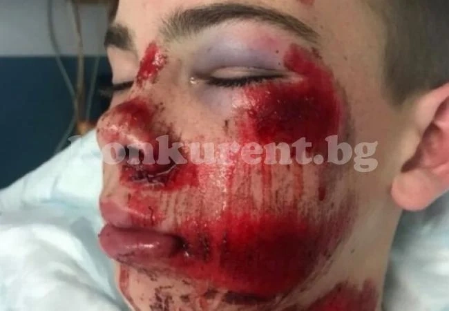 Майка предупреждава: Никога не позволявайте това, което аз на моя син, за малко да умре! (СНИМКИ 18+)