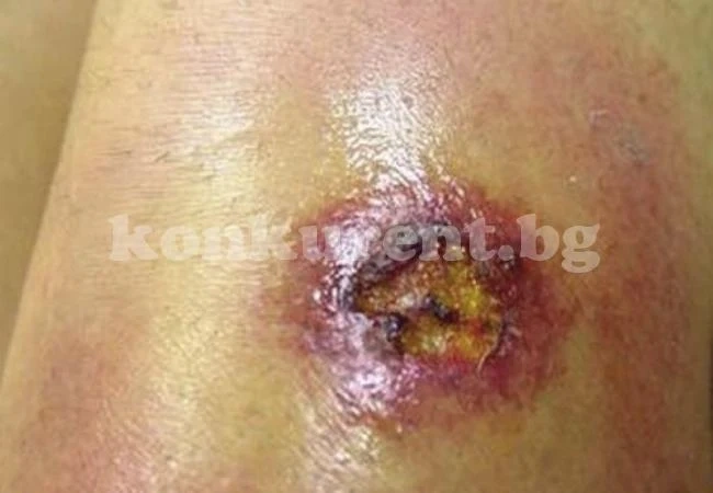 Жена започна да халюцинира и почти не получи удар, след като бе нахапана от десетки отровни паяци (СНИМКИ)