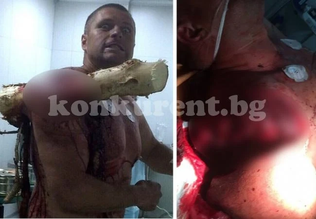 (СНИМКИ 18+) Хирурзите онемяха: Чудят се как този човек още е жив