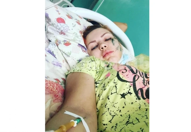 Млада жена отиде да се забавлява в караоке бар, но завърши вечерта в болница с обезобразено лице (СНИМКИ 18+)