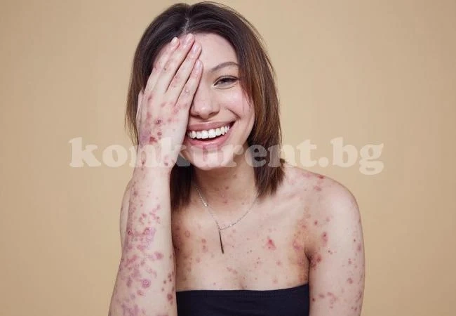 Красавица с тежка съдба: Мехурите по кожата ми сълзят с всяко докосване, но няма да се откажа от подиума (СНИМКИ)