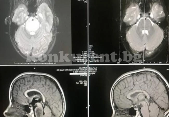 Чудо! 11-годишно момиченце се излекува от смъртоносна болест