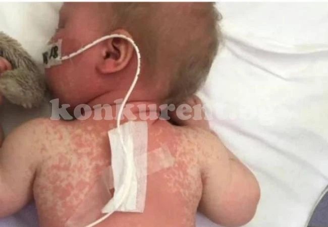 Майка показа зловещи СНИМКИ на бебе, болно от морбили