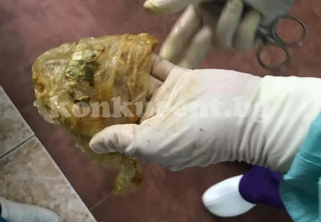 СНИМКИ 18+ Найлонов плик извадиха от червата на жена...