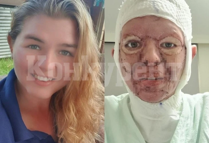 Смразяващата кръвта история на живата жена Франкенщайн СНИМКИ 18+
