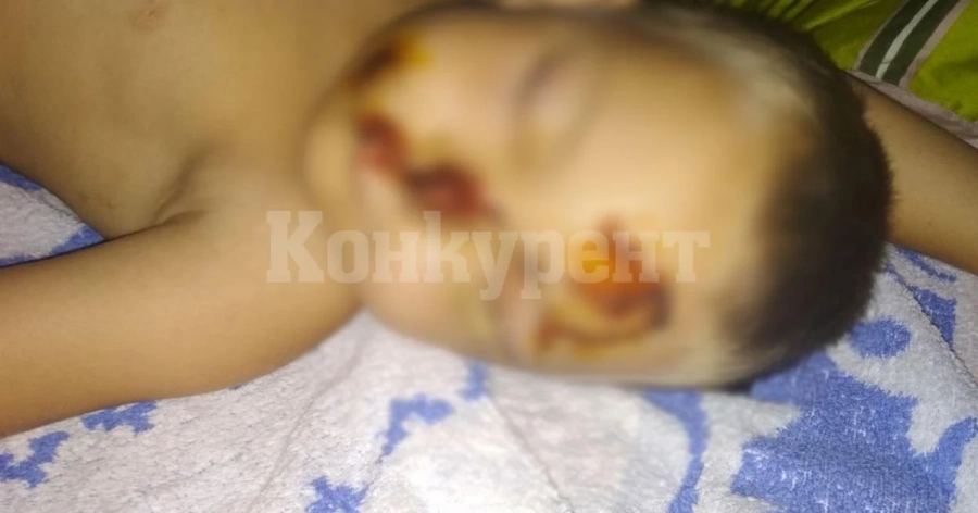 Дете е с над 100 шева след зверско ухапване от куче