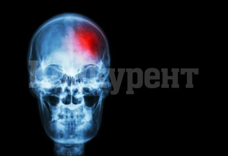 Невролог: Усетите ли това, най-вероятно получавате инсулт