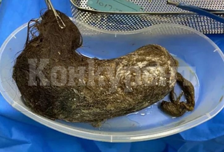 Ужасяващо! Огромна топка коса разкъса стомаха на момиче СНИМКА