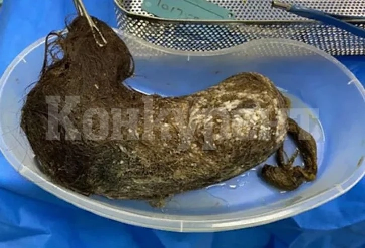 Ужасяващо! Огромна топка коса разкъса стомаха на момиче СНИМКА
