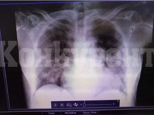 Страшно! Наши спешни медици показаха СНИМКА на бял дроб на 31 г. мъж с COVID-19