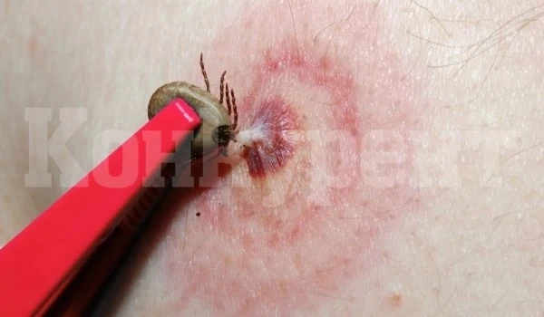 НАПАСТ: Стотици ухапани от кърлежи за броени дни