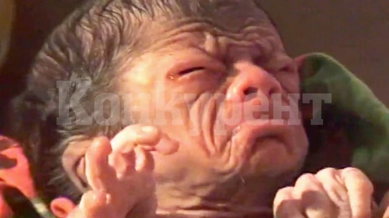 Жена роди дъщеря с рядък генетичен синдром