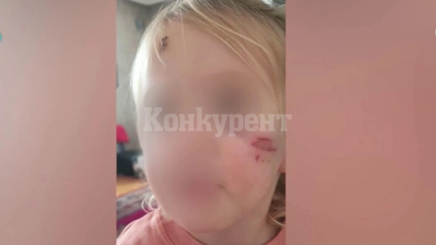 Дете е със сцепена буза след рязко спиране на такси