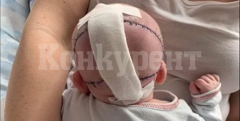 Изградиха череп! Спасиха живота на дете с уникална операция 