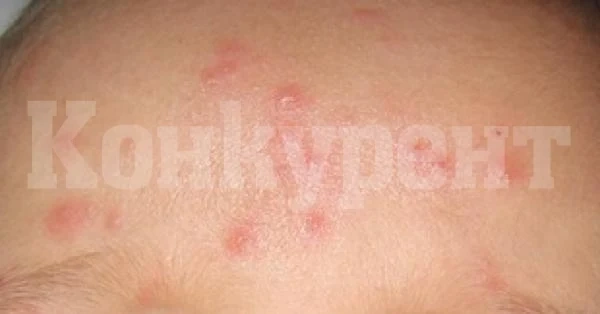 Двама с варицела и един със скарлатина установиха здравните власти във Враца
