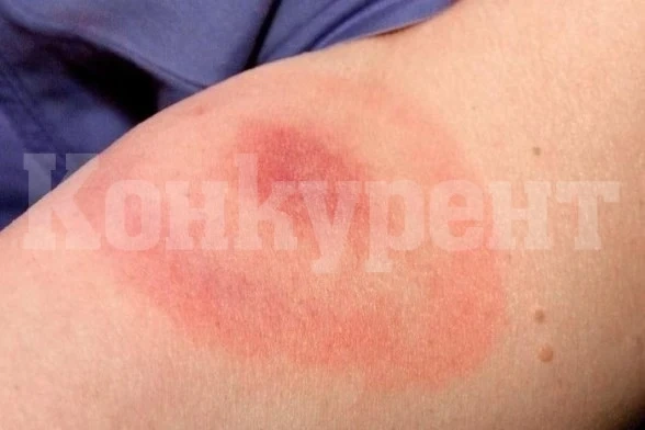 В Монтана е регистриран първият случай на Лаймска болест за това лято