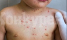 Намаляват заразените с варицела деца в Монтанско, увеличават се болните от хепатит