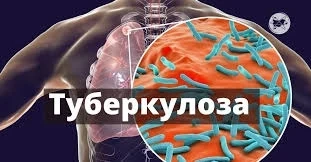 Петима с туберкулоза са открити в Монтанско за седмица