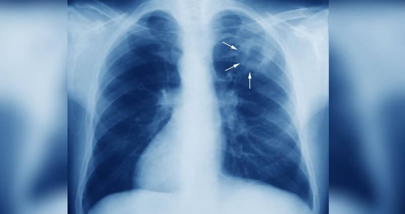 Бум на заразени с туберкулоза в Монтанско